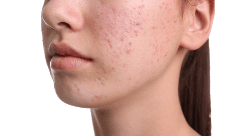 best 5 skin benefits of mandelic acid you must know