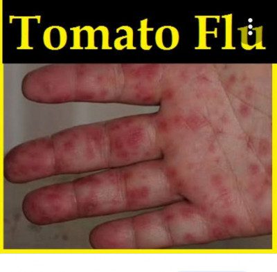 What Is Tomato Flu