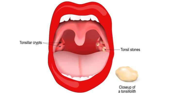 How to make tonsil stones fall out