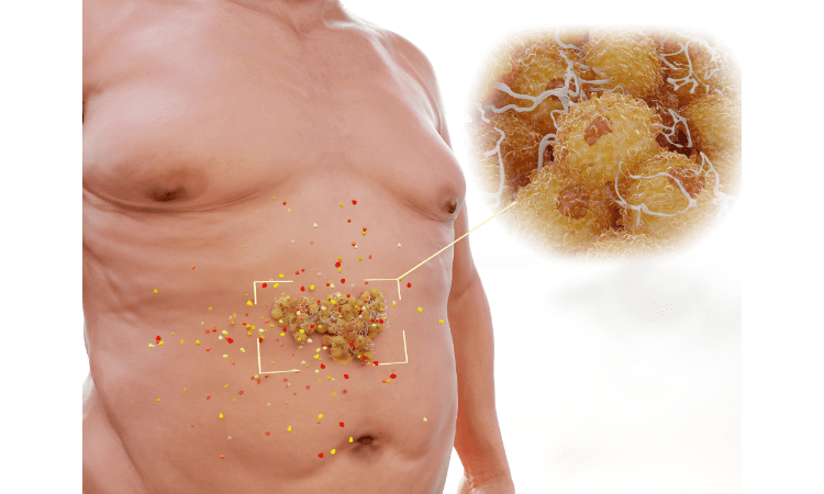 Signs You Need to see a Doctor About Your Visceral Fat