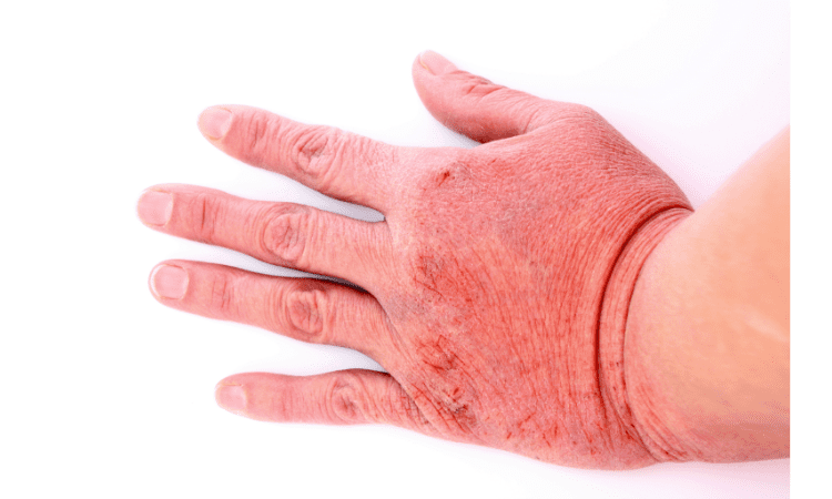 How Laundry Detergent Can Cause Contact Dermatitis